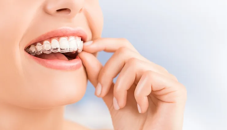 Orthodontic treatments for teeth alignment