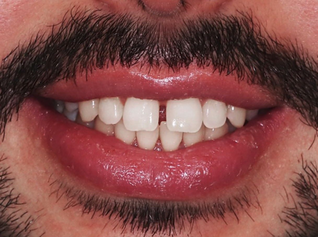 Close-up of man's teeth before Invisalign treatment, showing dental misalignment and uneven spacing.