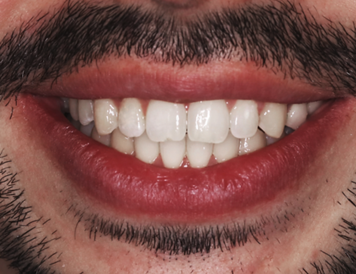 Close-up of man's teeth after Invisalign treatment, showcasing a straight, aligned smile and improved dental aesthetics.