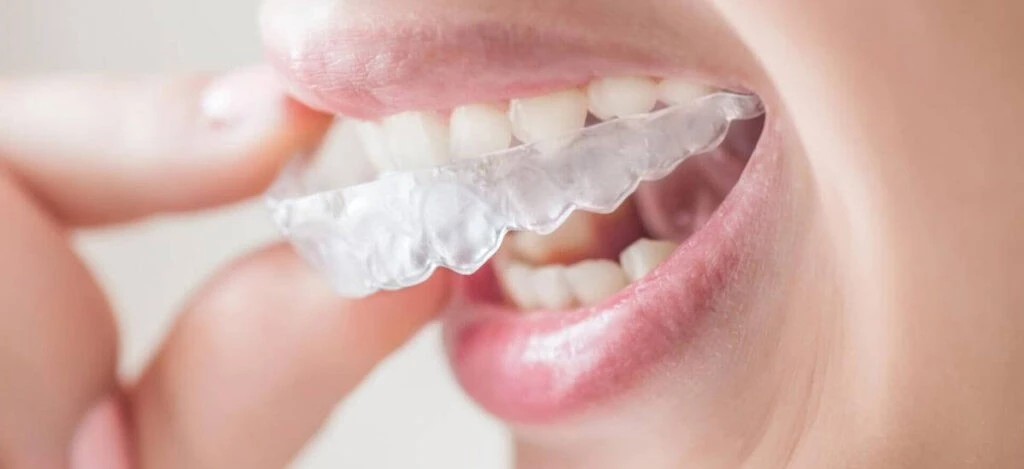Les Gouttières Invisibles Invisalign