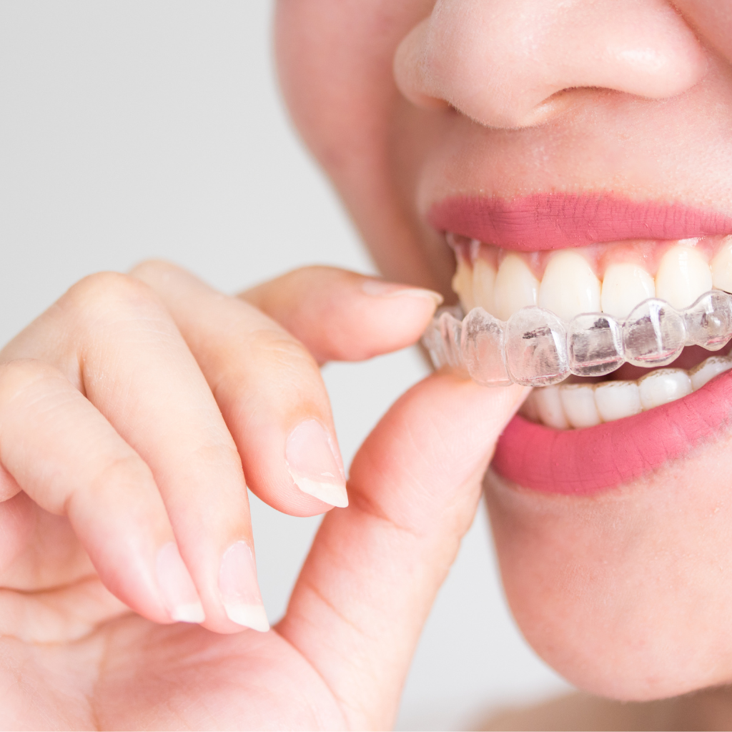 Comment Retirer Ses Gouttières Invisalign - HymySmile Clinic